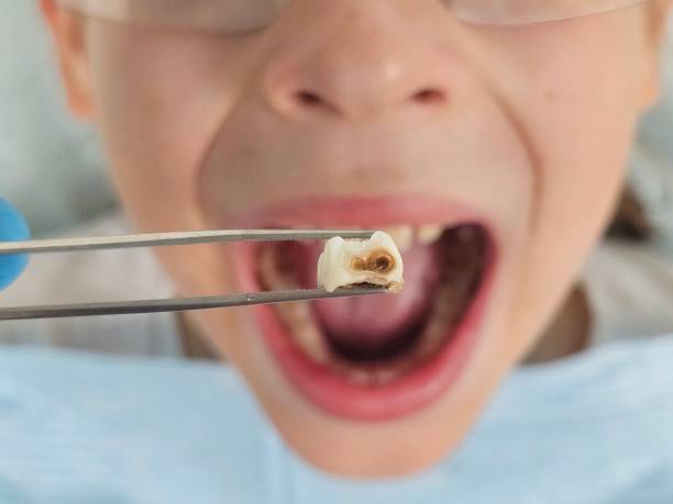 Best Emergency Dentist for Lost Fillings or Crowns in Middlebury, IN