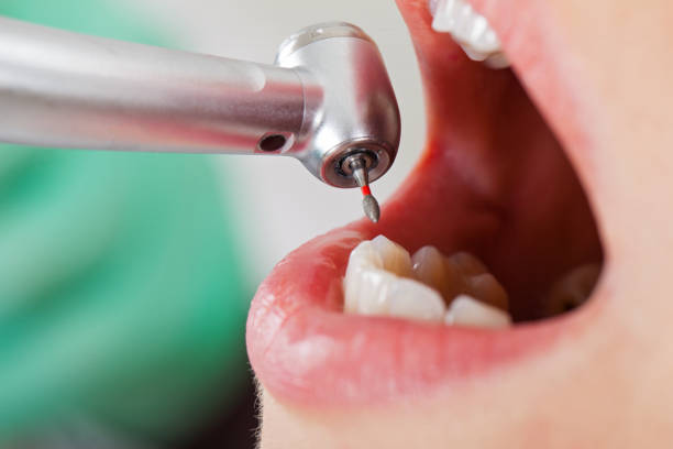 Best Emergency Dentist for Knocked-Out Tooth in Middlebury, IN
